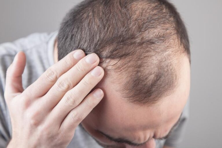 Hair Loss – 5 Causes and What You Can Do About Them