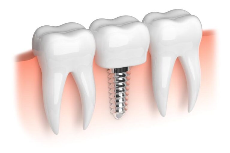 What Are Mini Implants?